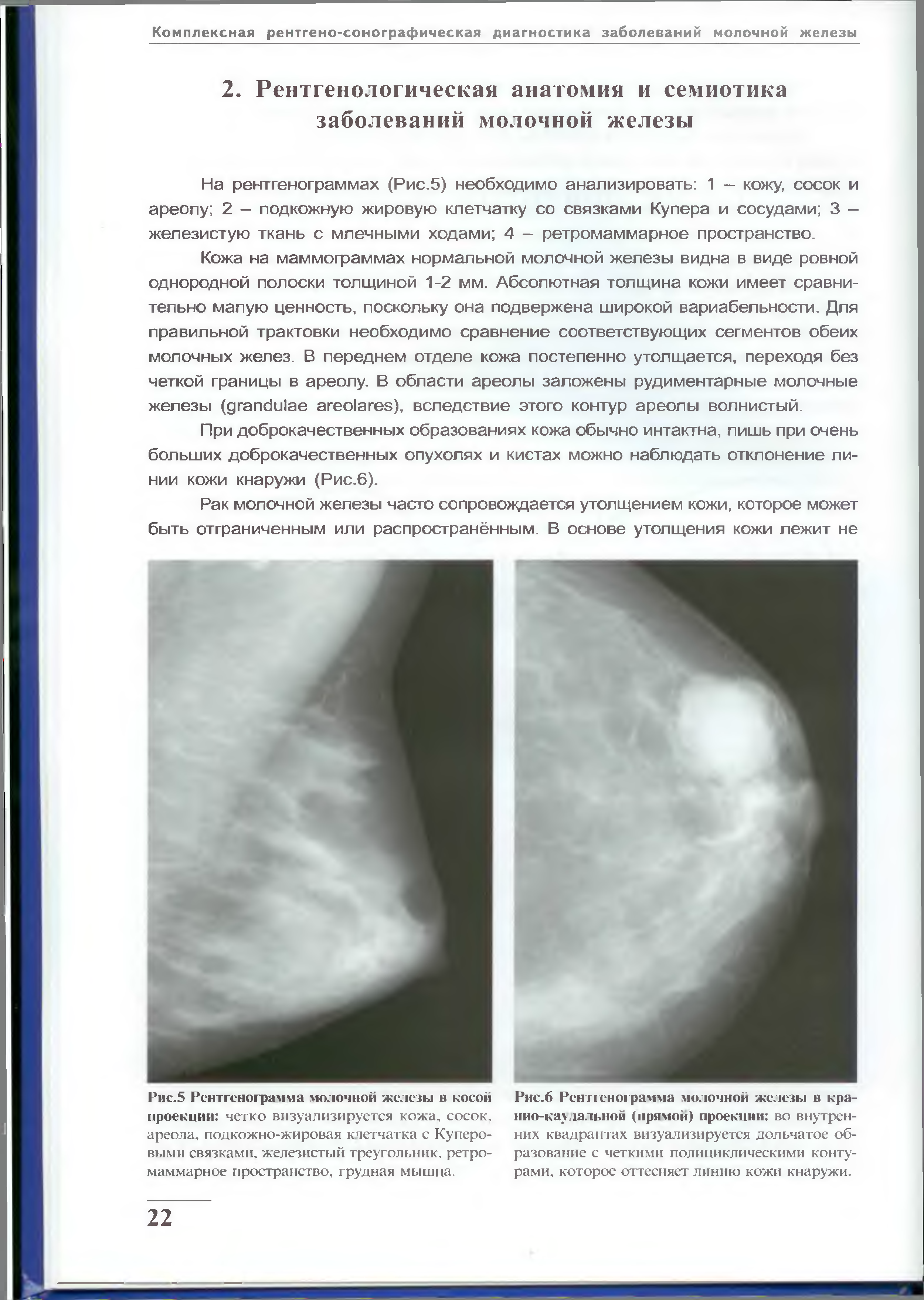 Фиброаденома молочной железы маммография заключение