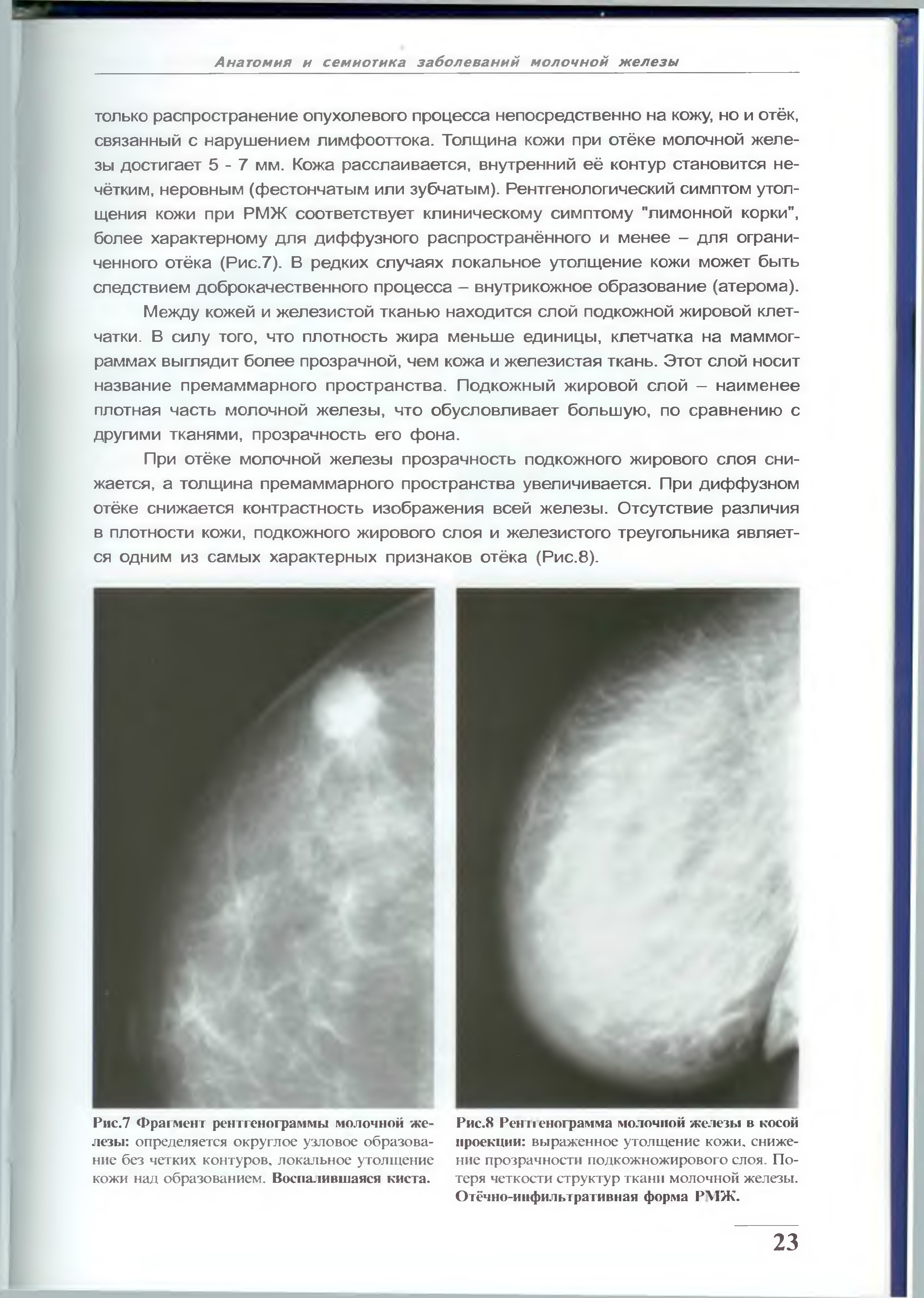 Анатомия молочной железы маммограмма