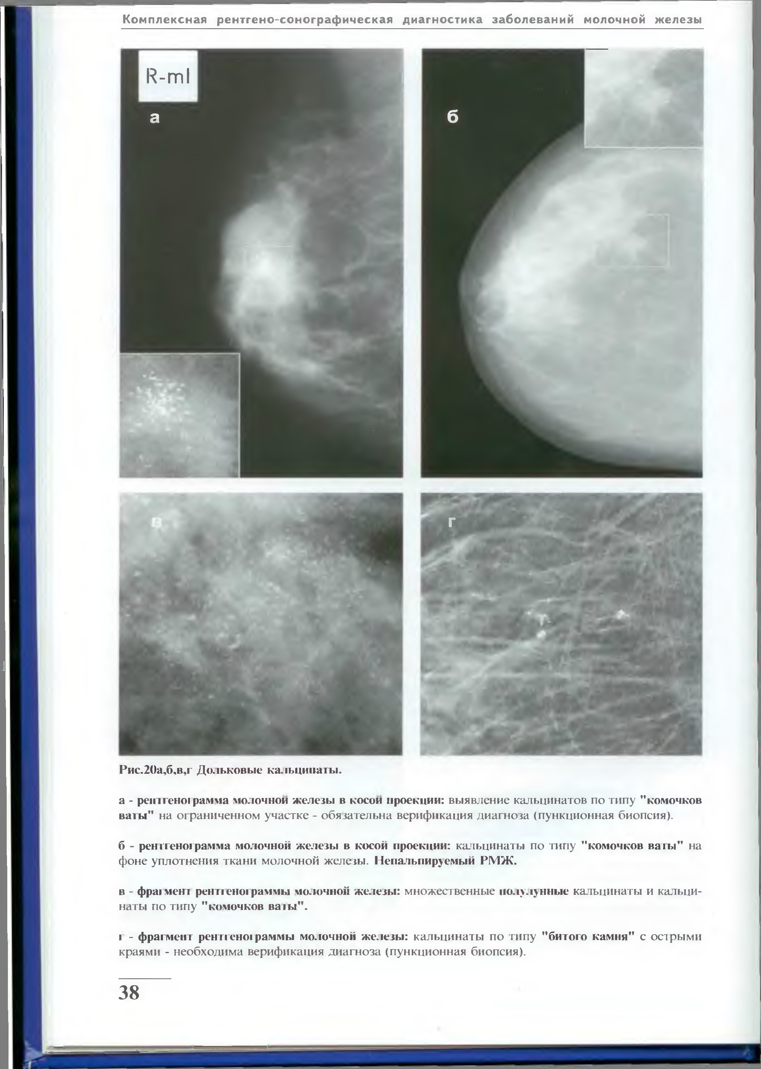 Маммография молочных желез снимки норма